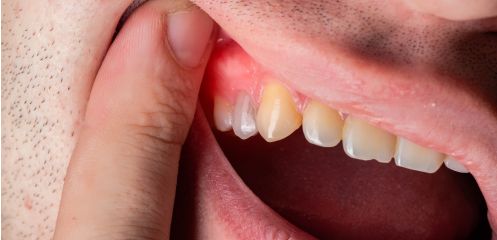 Swollen gum flap
